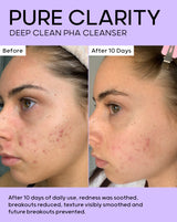After 10 days of daily use, redness was soothed and breakouts reduced