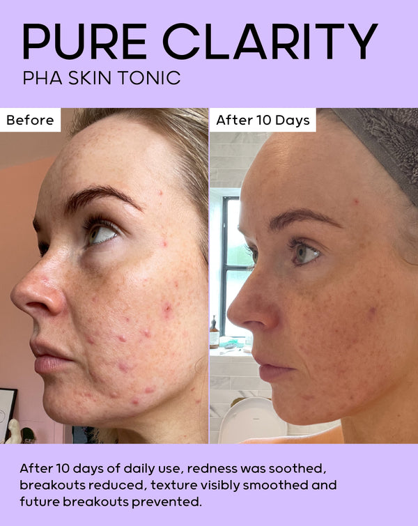 After 10 days of daily use, redness was soothed and breakouts reduced