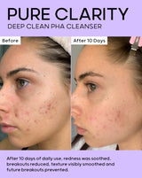 After 10 days of daily use, redness was soothed and breakouts reduced 
