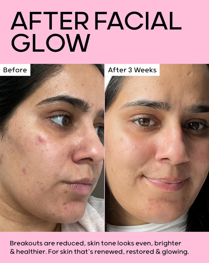 After 3 weeks, breakouts are reduced, skin tone looks even, brighter & healthier