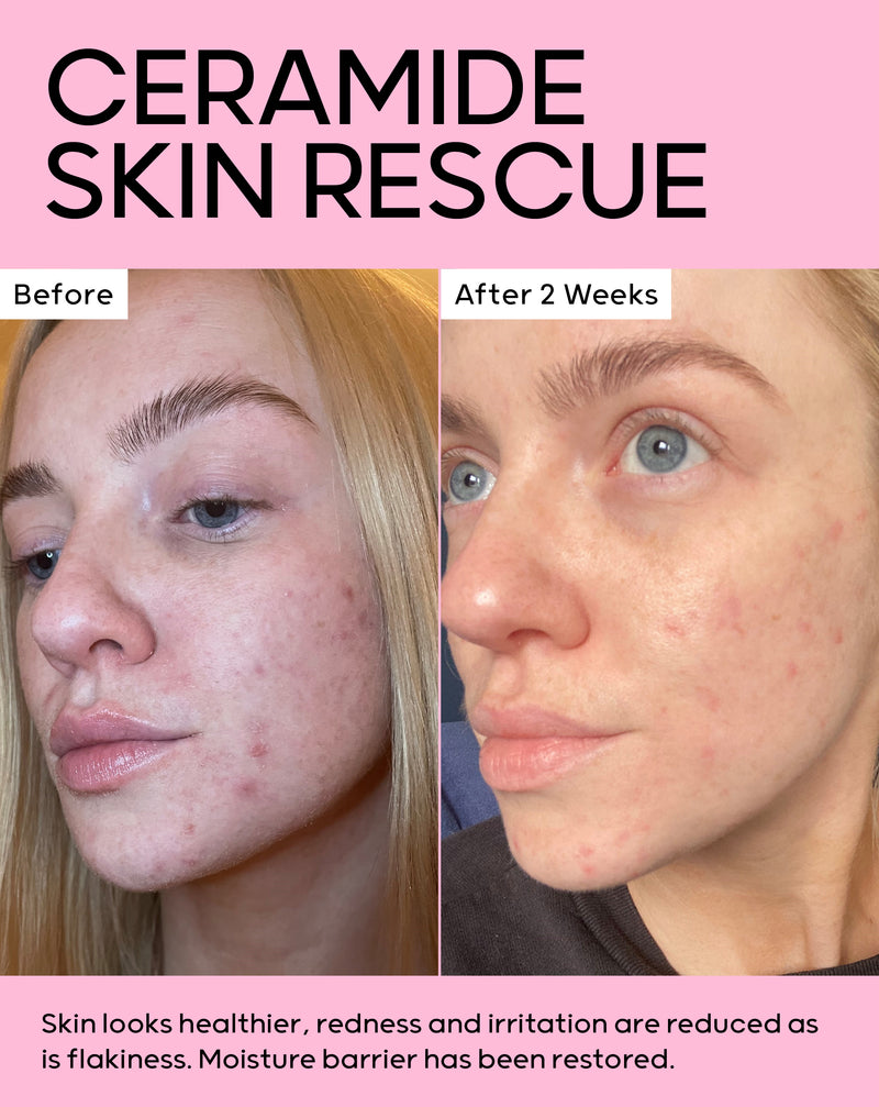 After 2 weeks skin looks healthier, redness and irritation are reduced